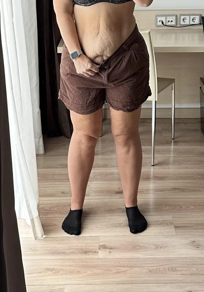Total Body Lift - Schönheits OP